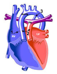 Transposisi Arteri Besar (TGA)